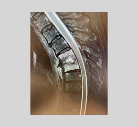 Spondylodiscites infectieuses