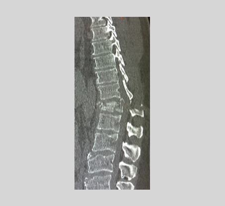 Traumatologie rachidienne