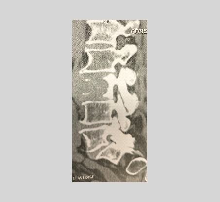 Tumeurs du rachis et métastases