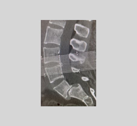 Spondylolisthésis