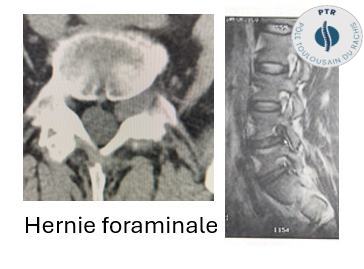 Hernie Discale Lombaire Docteur Jacques Boulot Chirurgien
