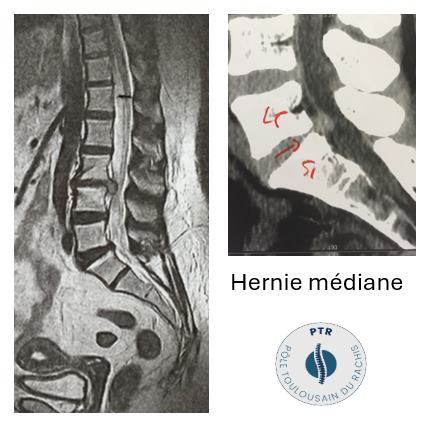 Hernie Discale Lombaire Docteur Jacques Boulot Chirurgien